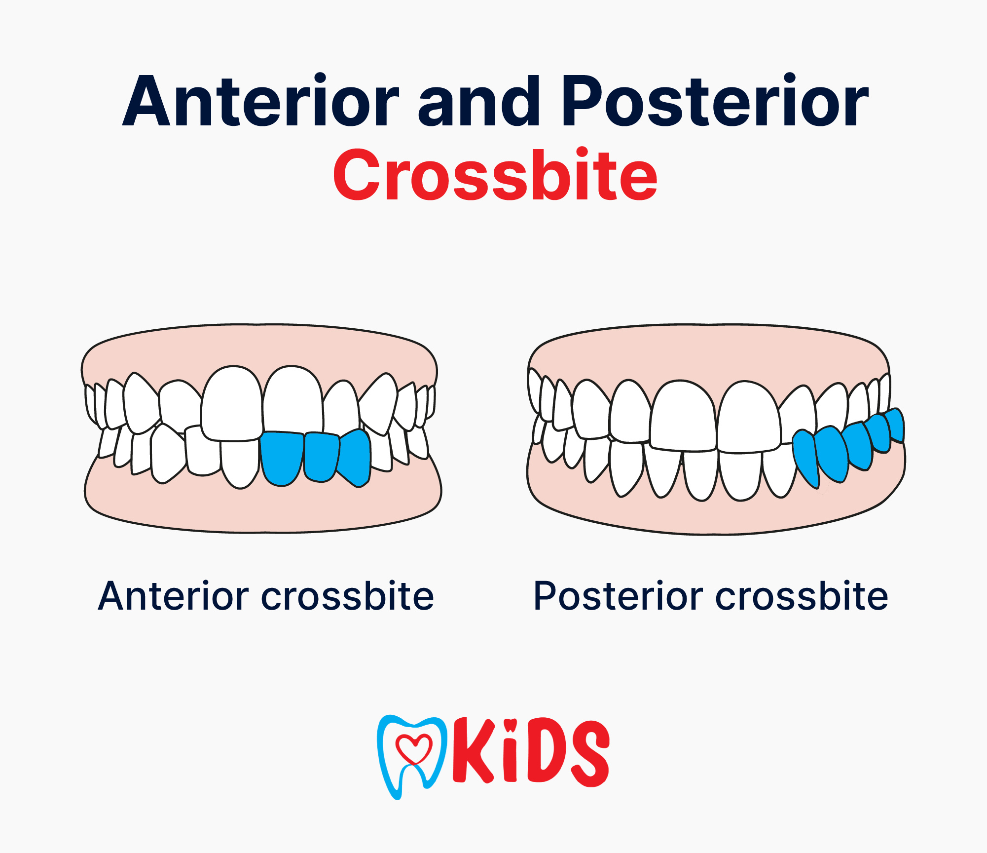 anterior and posterior crossbite