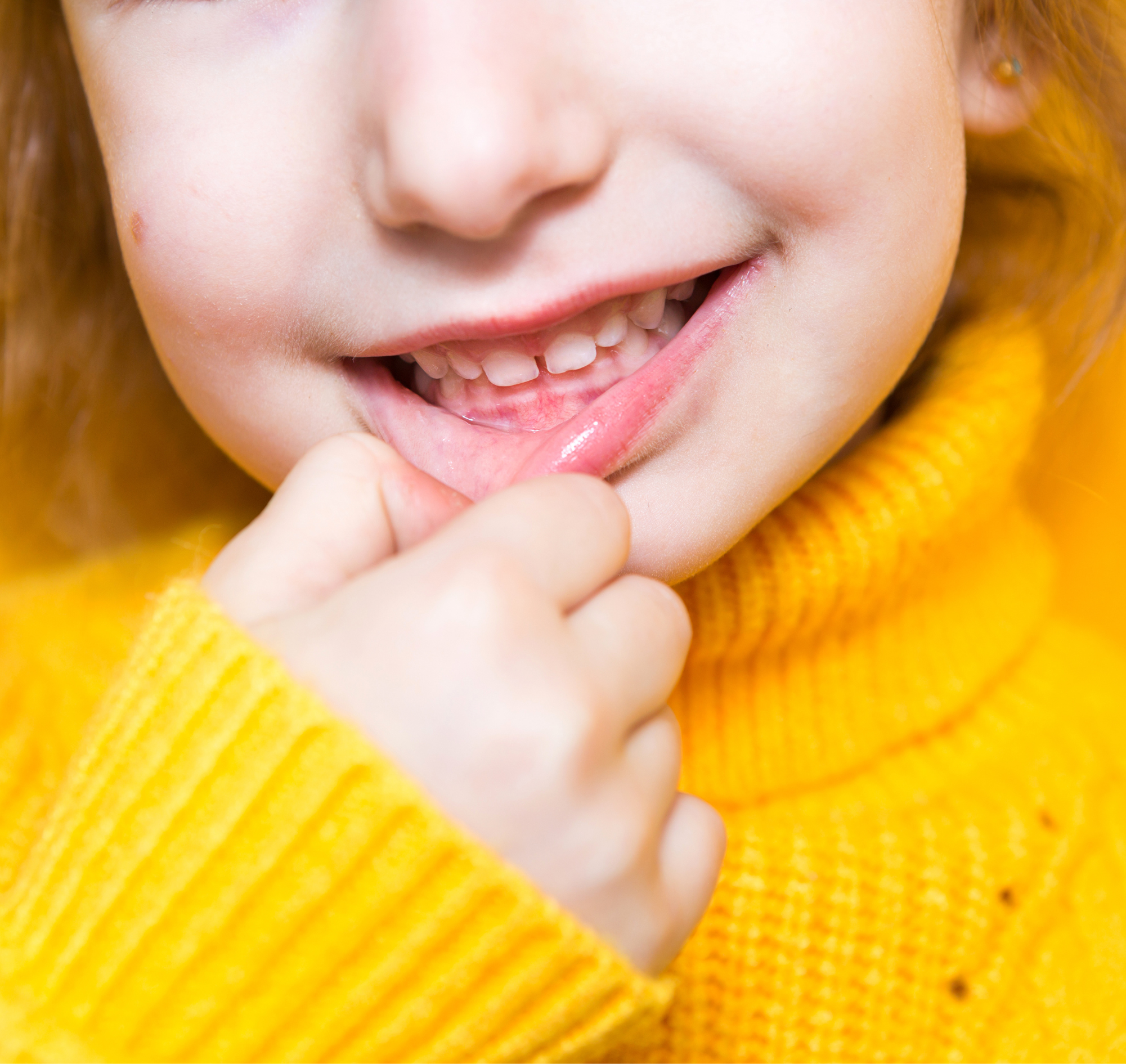 Overbite