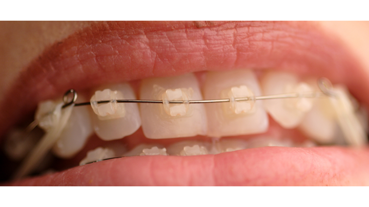 How to Tell When It’s Time For Braces