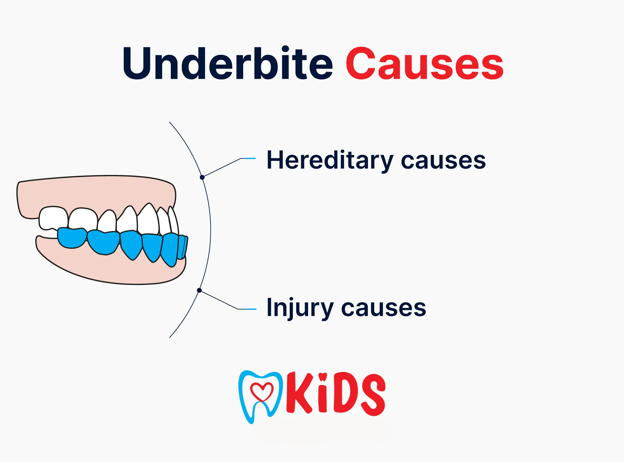 Underbite causes